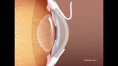 lasik surgery