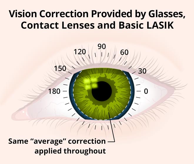lasik