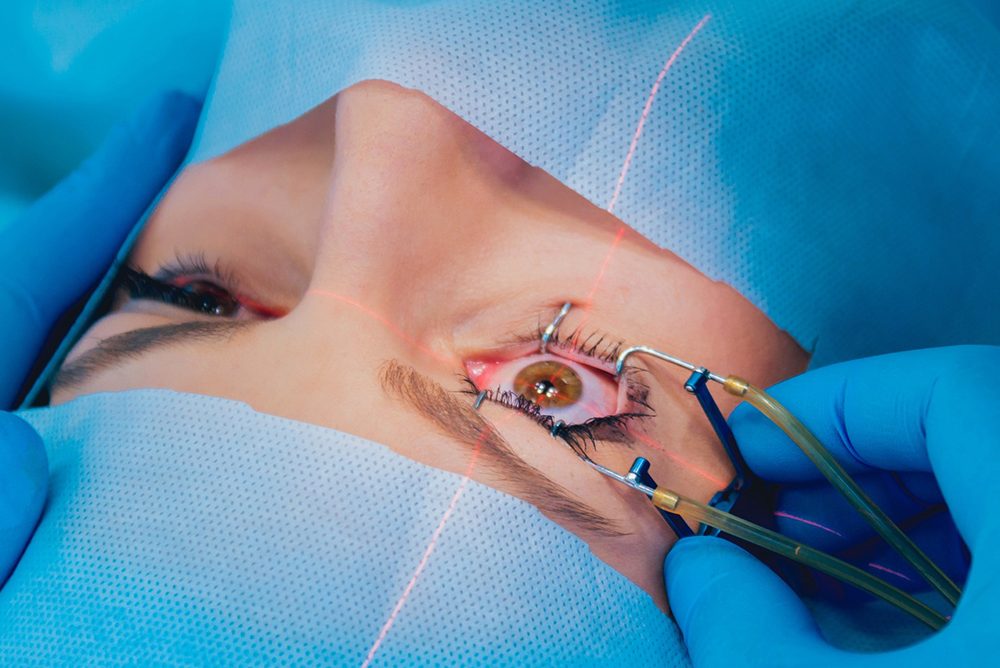 lasik surgery