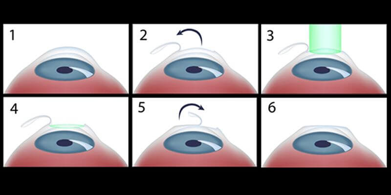 lasik