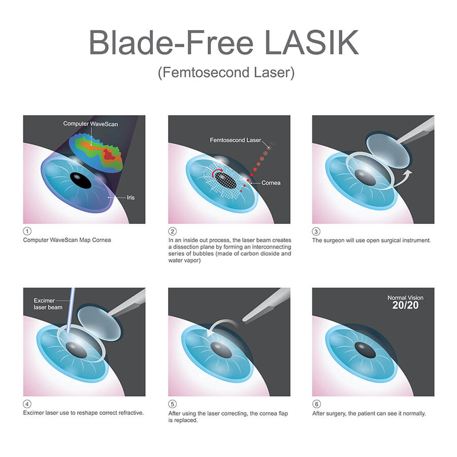 lasik surgery