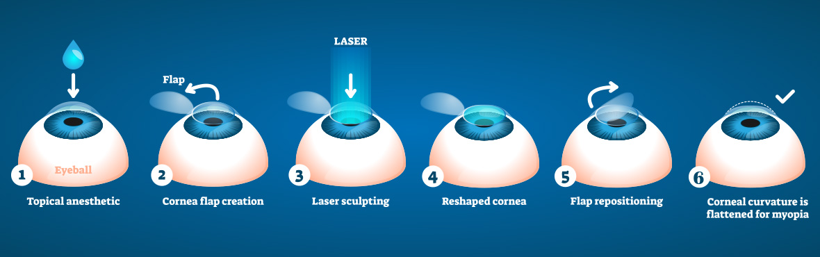 lasik