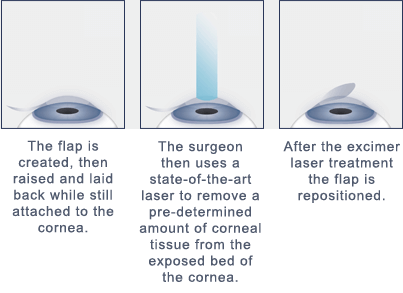 lasik surgery