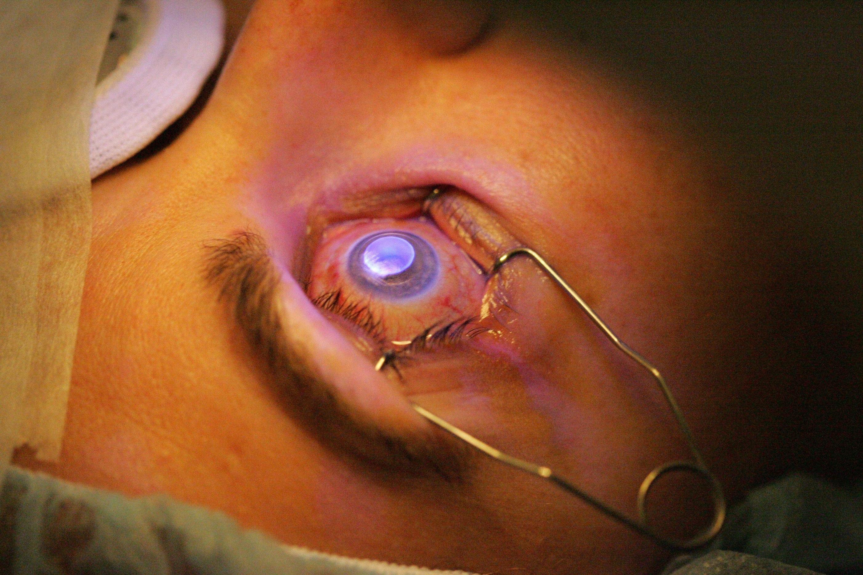 lasik