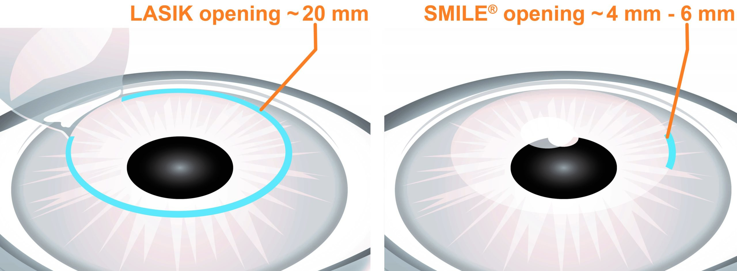 lasik surgery