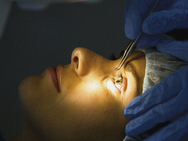 eye surgery