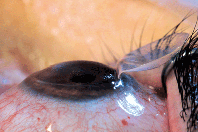 lasik surgery