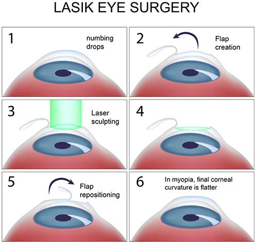 lasik