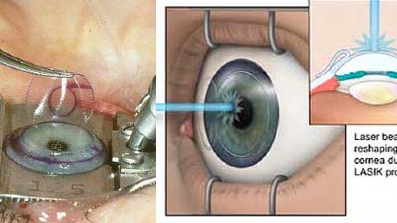 lasik surgery